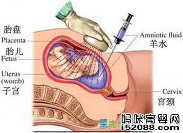 羊水穿刺检查示意图