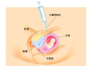 人工羊膜穿破术引产