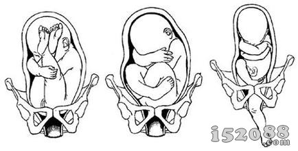 育儿网为您解读胎位异常的危害及表现