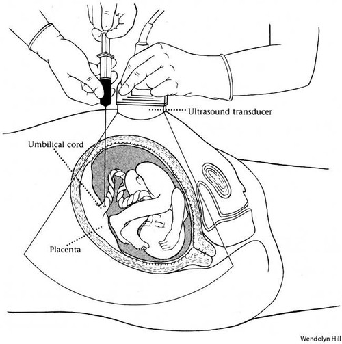 孕期常识：人工羊膜穿破术引产